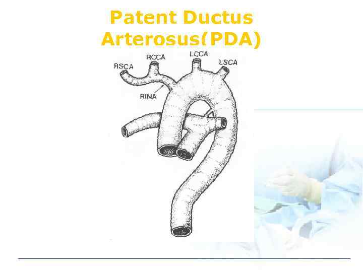 Patent Ductus Arterosus(PDA) 
