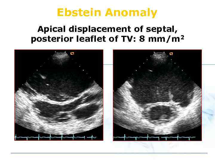 Ebstein Anomaly Apical displacement of septal, posterior leaflet of TV: 8 mm/m 2 