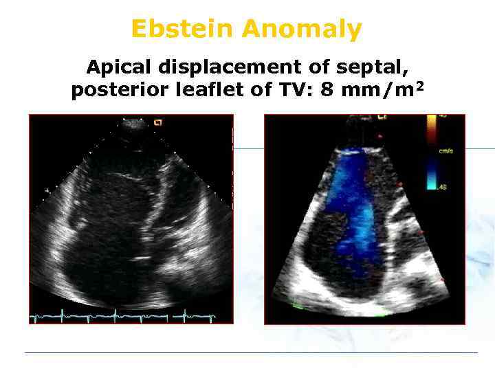 Ebstein Anomaly Apical displacement of septal, posterior leaflet of TV: 8 mm/m 2 