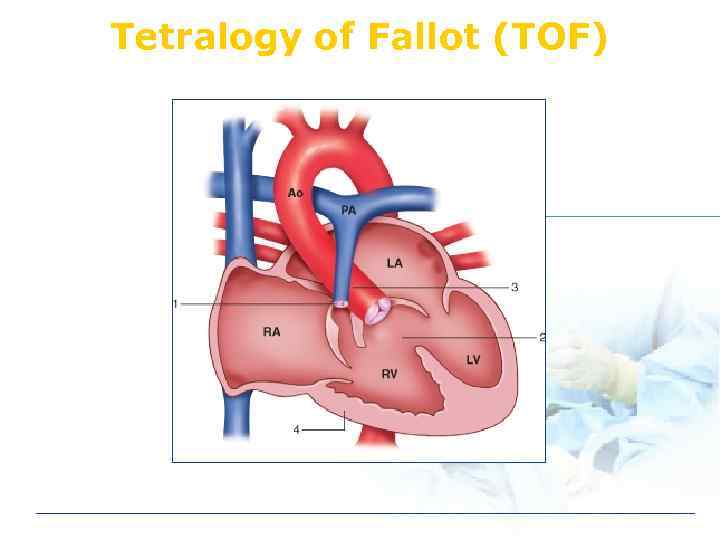 Tetralogy of Fallot (TOF) 