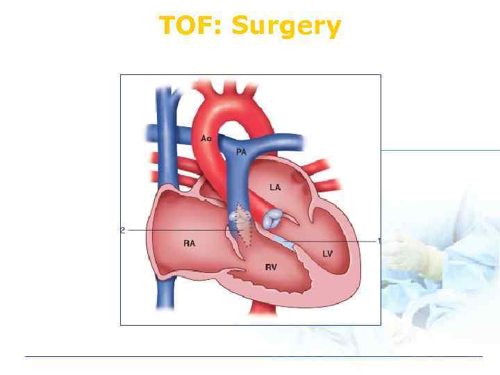 TOF: Surgery 
