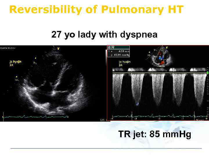 Reversibility of Pulmonary HT 27 yo lady with dyspnea TR jet: 85 mm. Hg