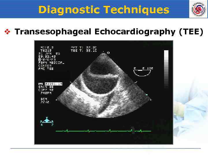 Diagnostic Techniques v Transesophageal Echocardiography (TEE) 