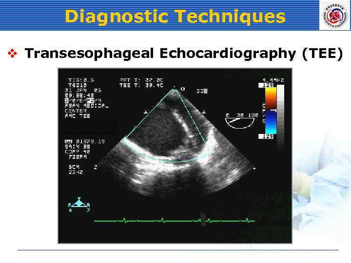 Diagnostic Techniques v Transesophageal Echocardiography (TEE) 