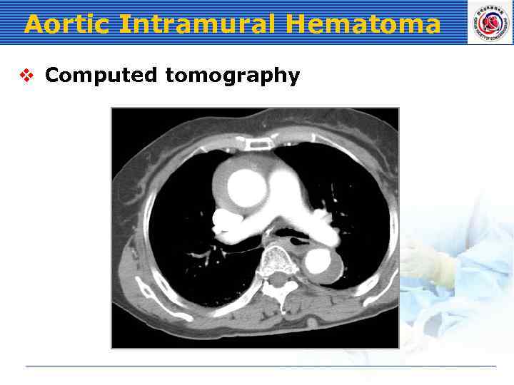 Aortic Intramural Hematoma v Computed tomography 