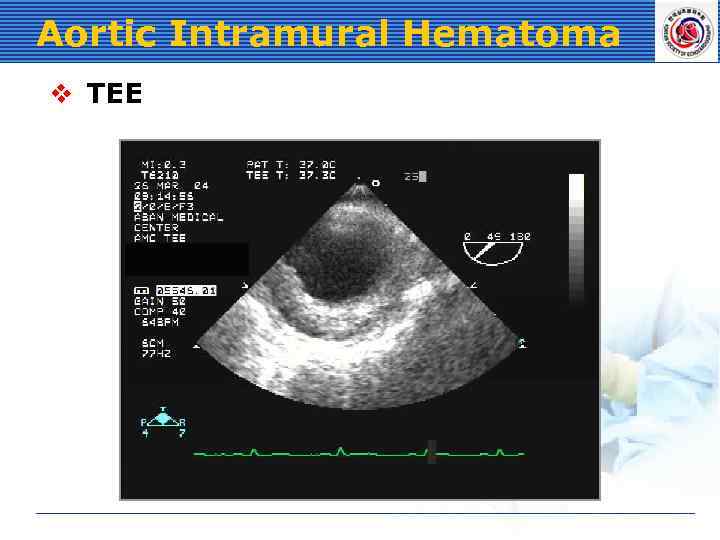 Aortic Intramural Hematoma v TEE 