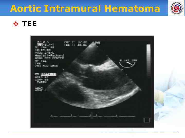 Aortic Intramural Hematoma v TEE 