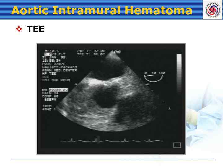 Aortic Intramural Hematoma v TEE 