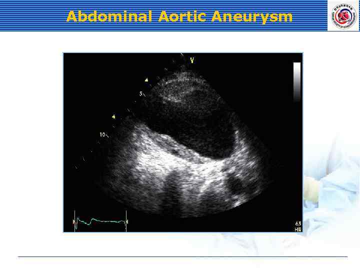 Abdominal Aortic Aneurysm 