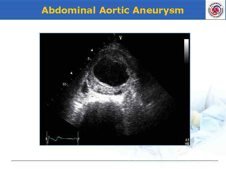 Abdominal Aortic Aneurysm 