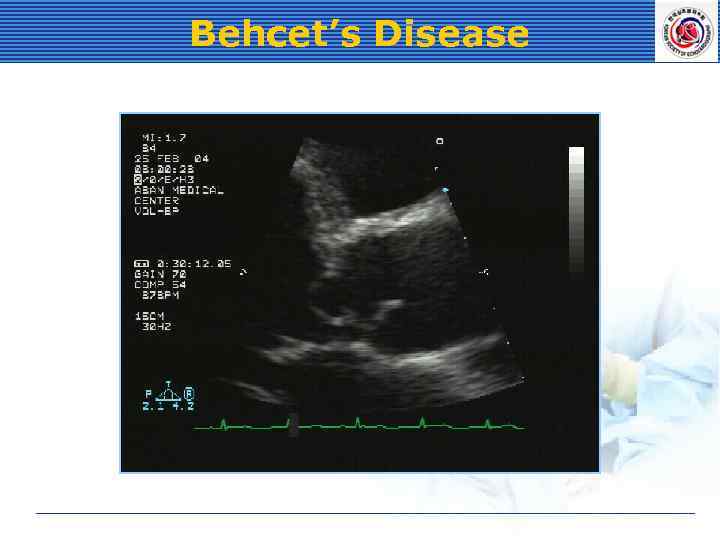 Behcet’s Disease 