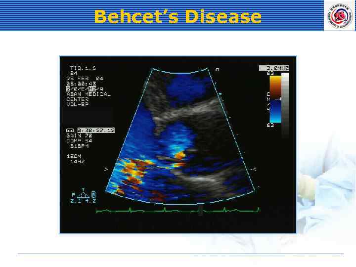 Behcet’s Disease 