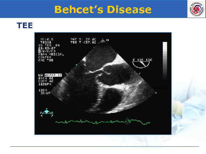 Behcet’s Disease TEE 