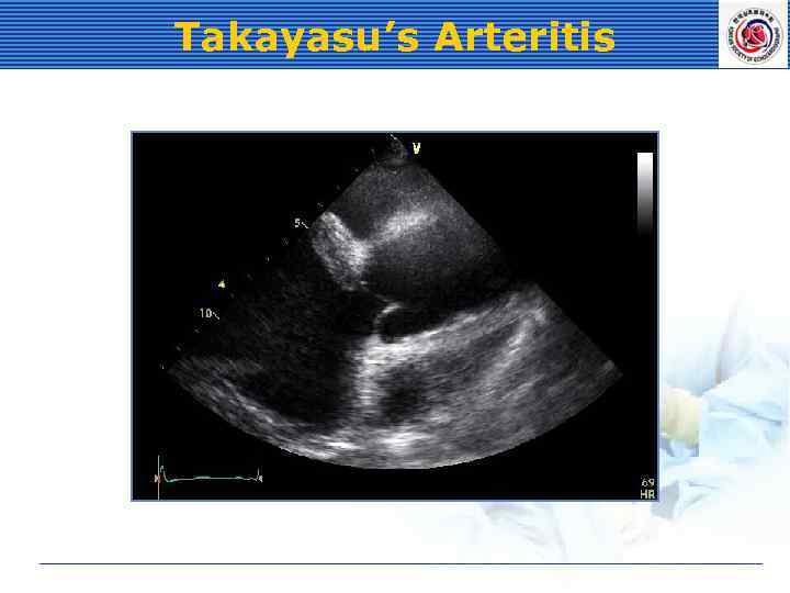 Takayasu’s Arteritis 
