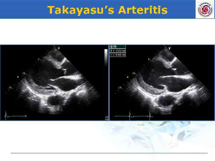 Takayasu’s Arteritis 