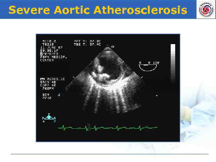 Severe Aortic Atherosclerosis 