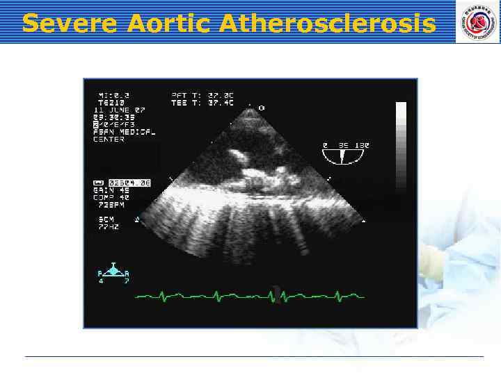 Severe Aortic Atherosclerosis 