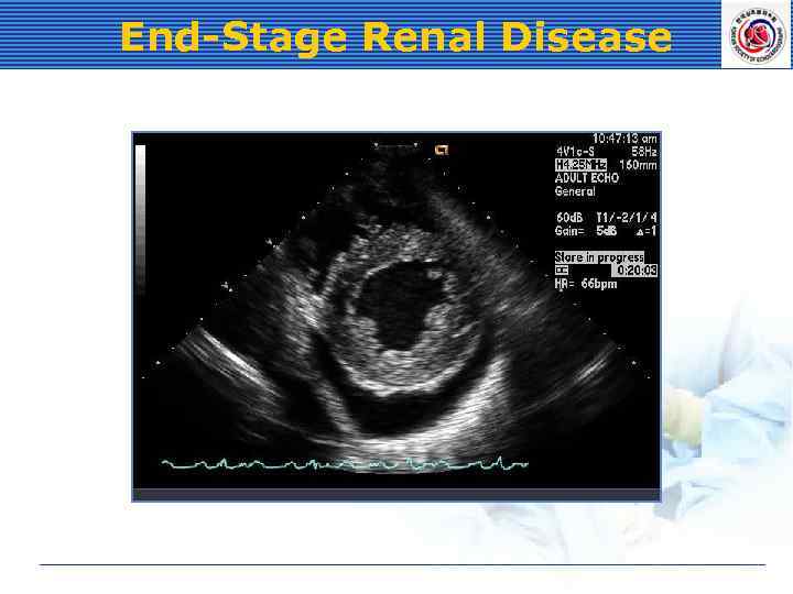 End-Stage Renal Disease 