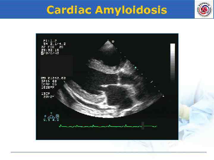 Cardiac Amyloidosis 