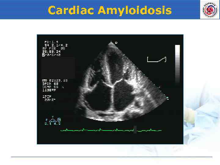 Cardiac Amyloidosis 