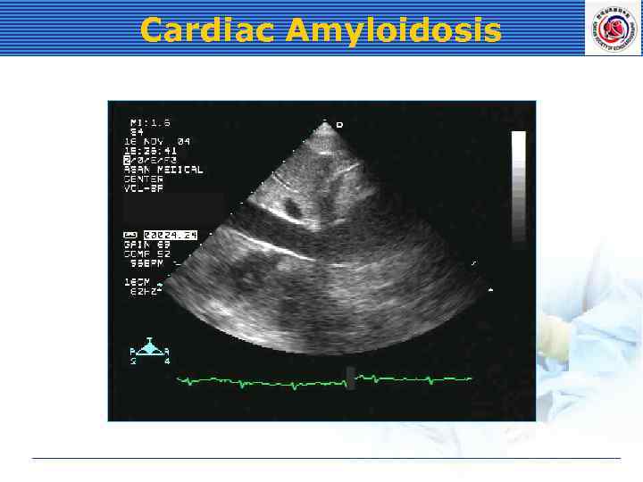 Cardiac Amyloidosis 