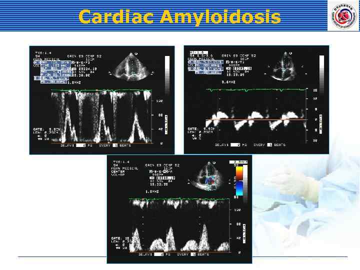 Cardiac Amyloidosis 