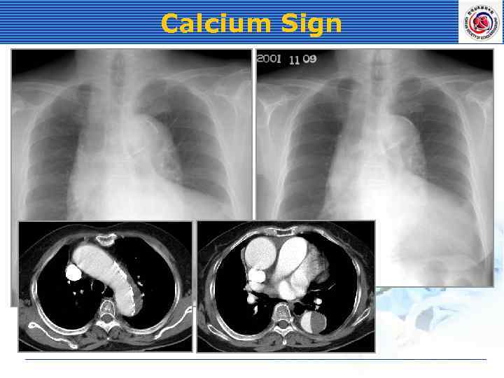 Calcium Sign 