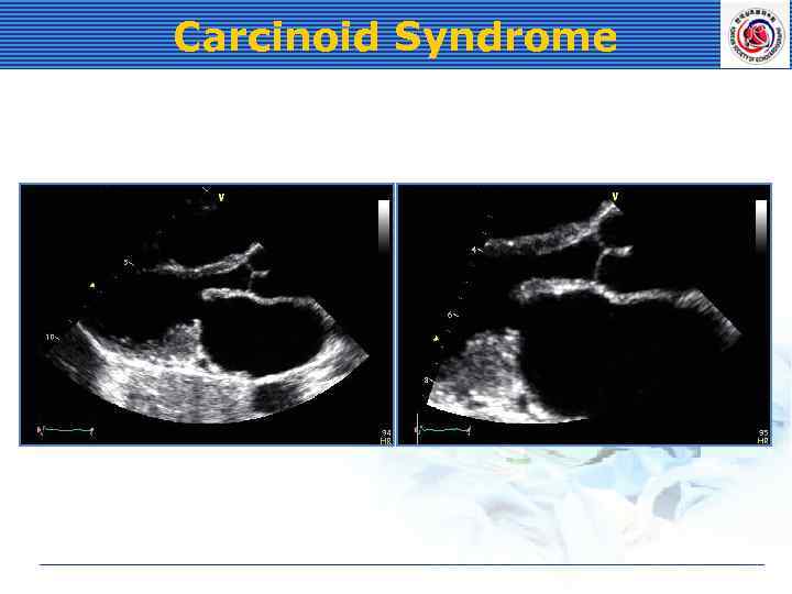 Carcinoid Syndrome 