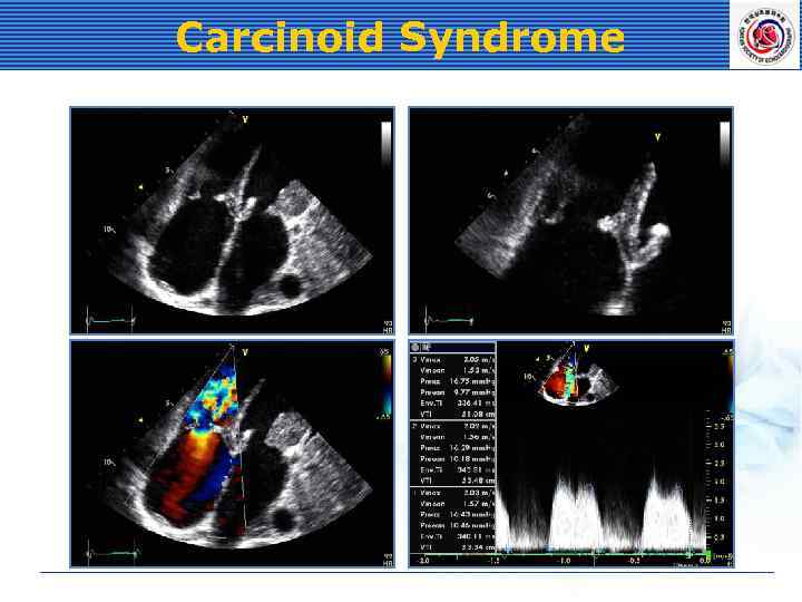 Carcinoid Syndrome 
