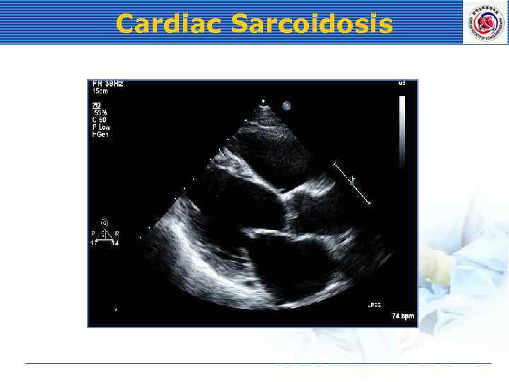 Cardiac Sarcoidosis 