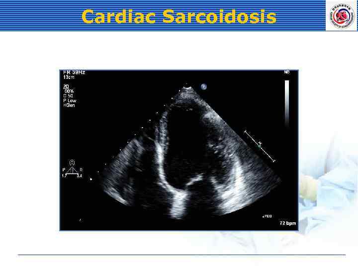 Cardiac Sarcoidosis 