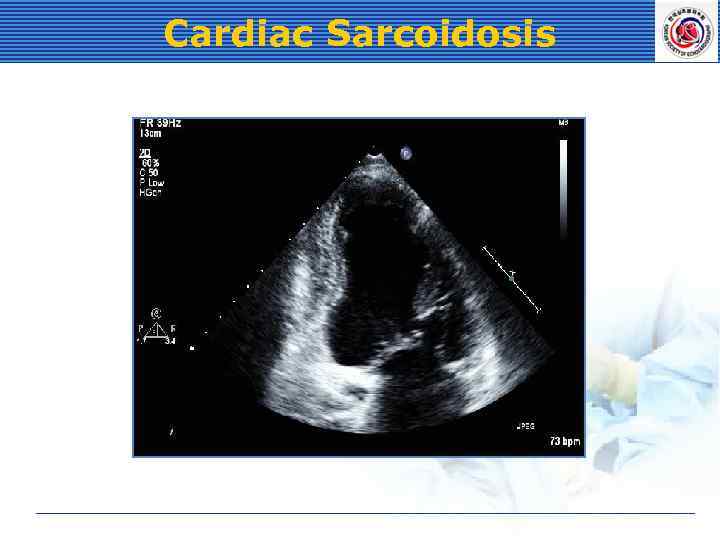 Cardiac Sarcoidosis 