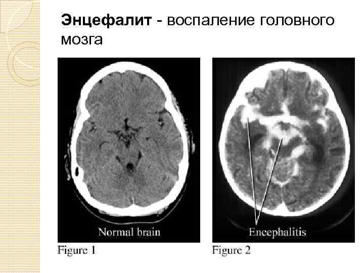 Воспаление мозга на латинском. Герпетический энцефалит мрт. Энцефалит головного мозга. Воспаление головного мозга.