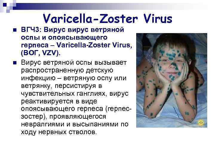 Varicella-Zoster Virus n n ВГЧ 3: Вирус ветряной оспы и опоясывающего герпеса – Varicella-Zoster