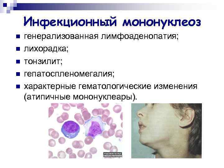 Инфекционный мононуклеоз n n n генерализованная лимфоаденопатия; лихорадка; тонзилит; гепатоспленомегалия; характерные гематологические изменения (атипичные