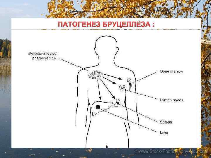 ПАТОГЕНЕЗ БРУЦЕЛЛЁЗА : 