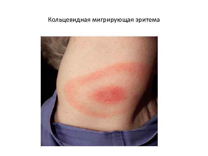 Кольцевидная мигрирующая эритема 