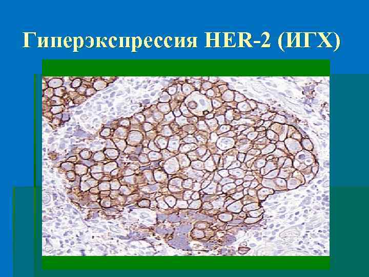 Гиперэкспрессия HER-2 (ИГХ) 