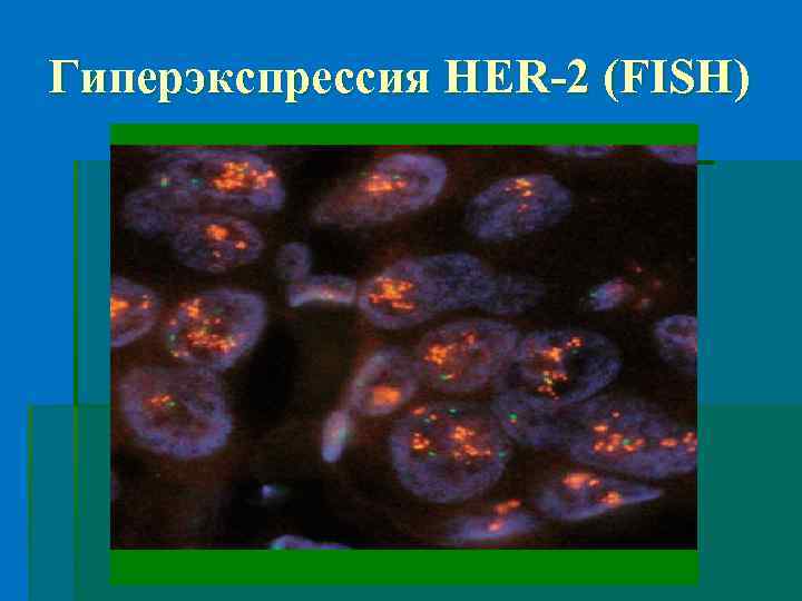 Гиперэкспрессия HER-2 (FISH) 