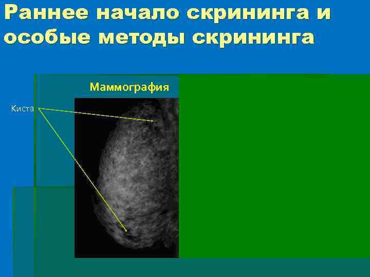 Раннее начало скрининга и особые методы скрининга Маммография Киста МРТ 
