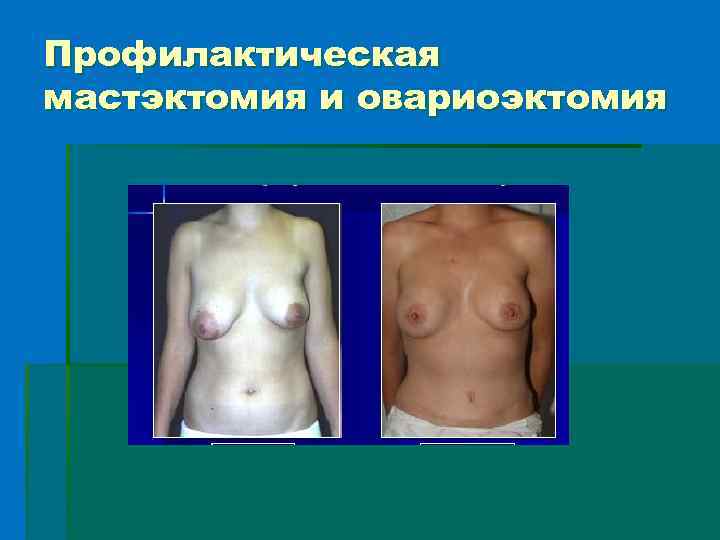 Профилактическая мастэктомия и овариоэктомия 