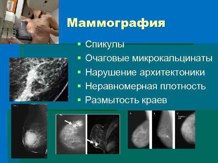 Маммография § § § Спикулы Очаговые микрокальцинаты Нарушение архитектоники Неравномерная плотность Размытость краев 