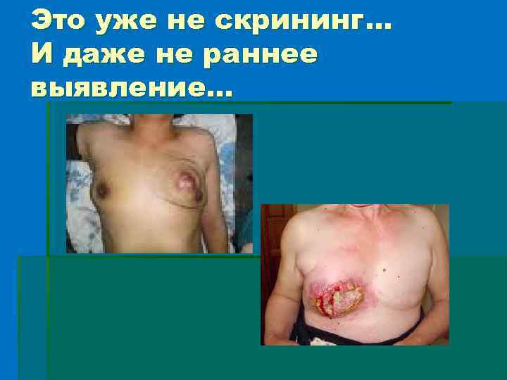 Это уже не скрининг… И даже не раннее выявление… 
