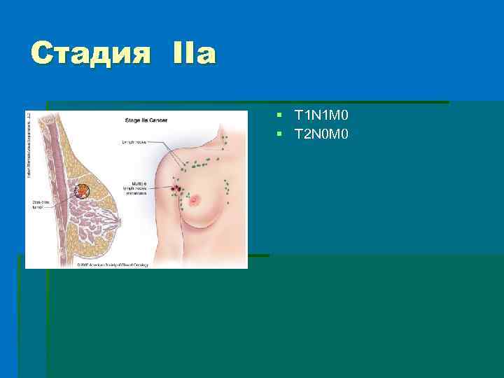 Стадия IIa § T 1 N 1 M 0 § T 2 N 0