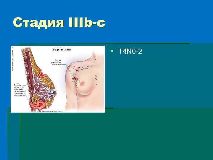 Стадия IIIb-c § T 4 N 0 -2 