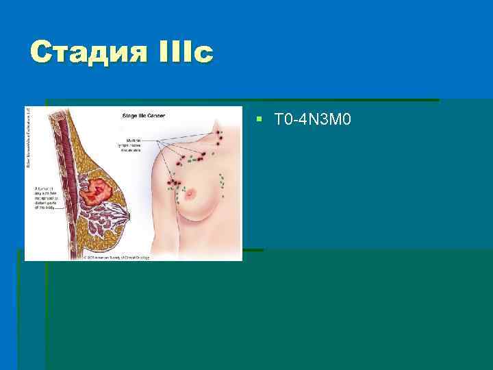 Стадия IIIc § T 0 -4 N 3 M 0 