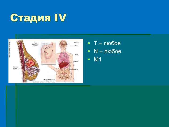 Стадия IV § § § Т – любое N – любое М 1 