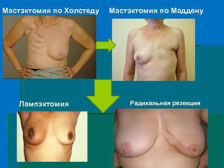 Мастэктомия по Холстеду Лампэктомия Мастэктомия по Маддену Радикальная резекция 