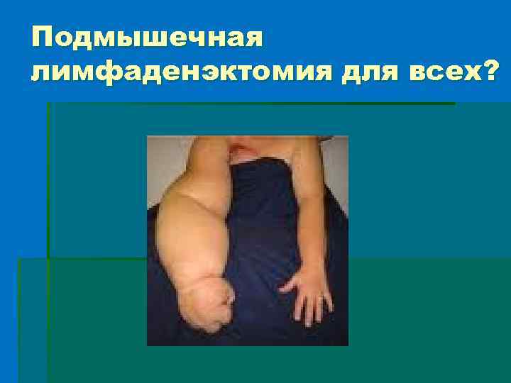 Подмышечная лимфаденэктомия для всех? 