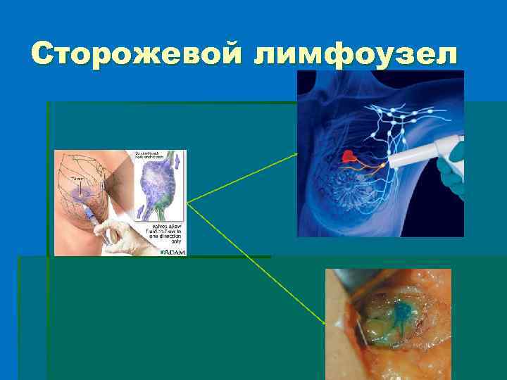 Сторожевой лимфоузел 